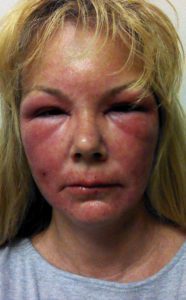 poison oak